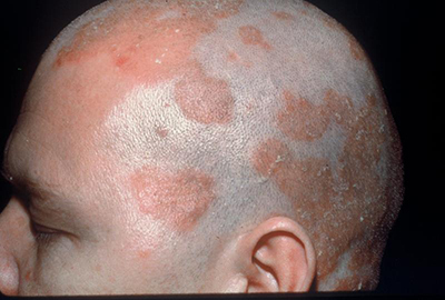 脂漏性皮膚炎の原因と必須改善法