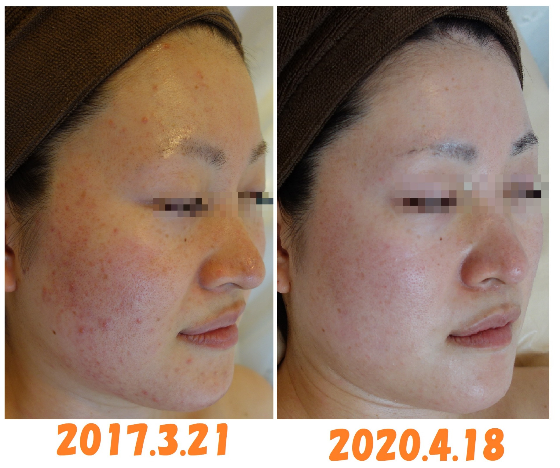 ニキビ赤ら顔からの肌質改善症例！姫路で本当にキレイな肌を作るなら