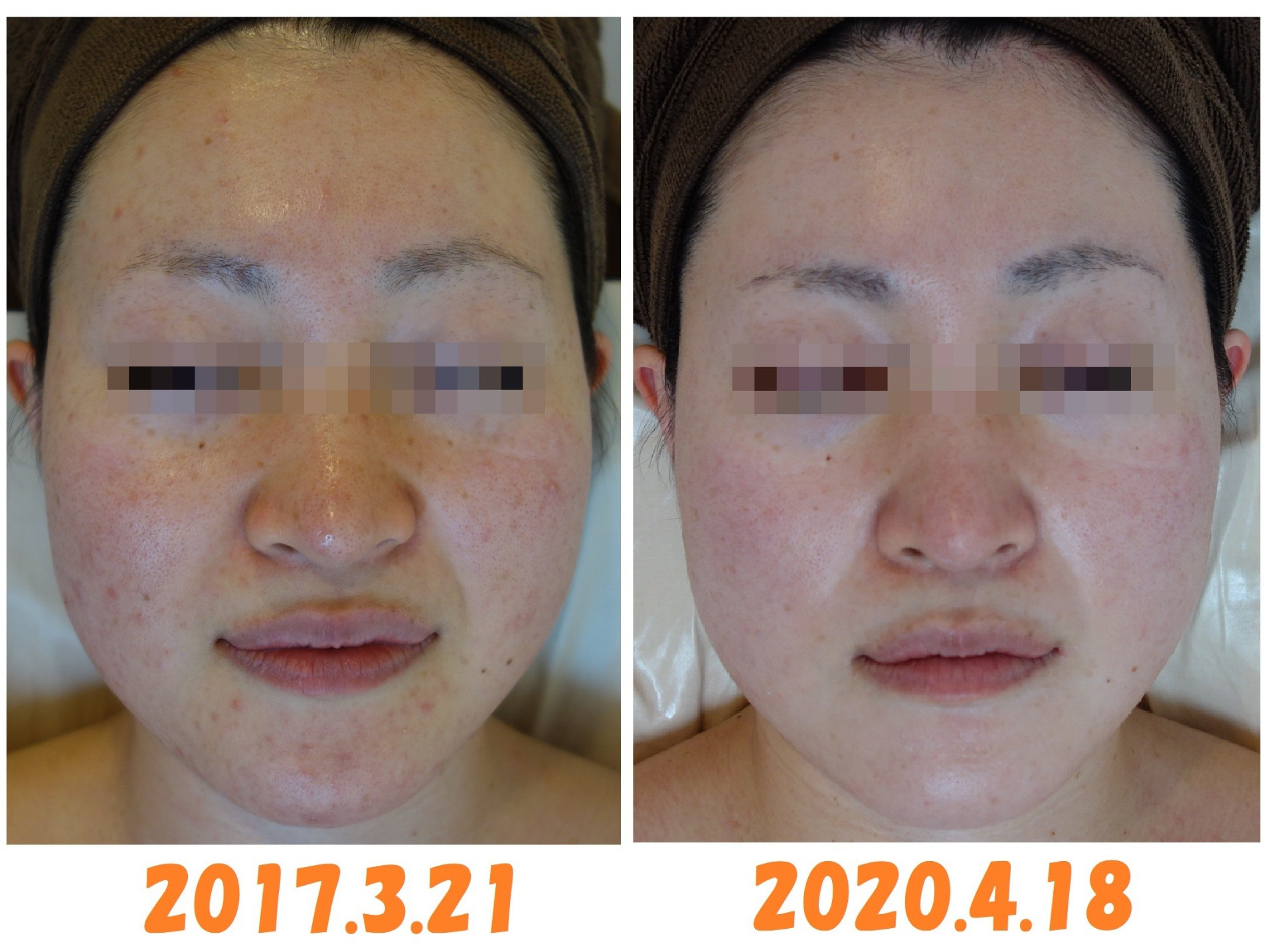 ニキビ赤ら顔からの肌質改善症例 姫路で本当にキレイな肌を作るなら 姫路のエステ ラグランシエルではブログでも様々な情報を発信しております