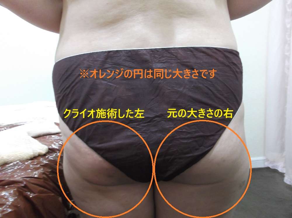 【ダイエット】半身モニター様の結果２【脂肪冷却クライオ】