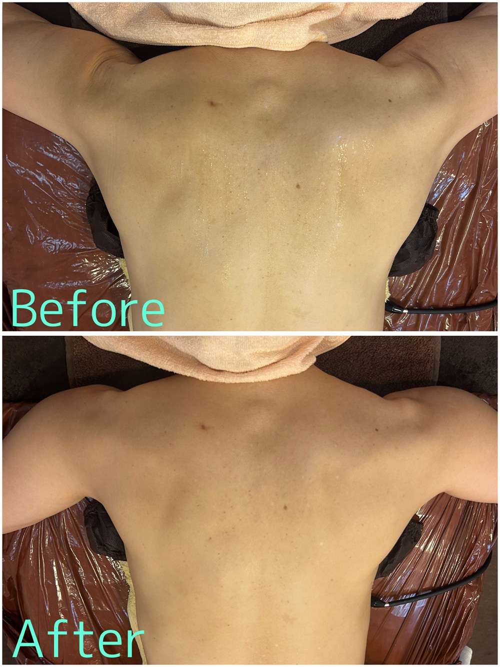 【筋膜リリース】60代Y様【フィジカルキュー】