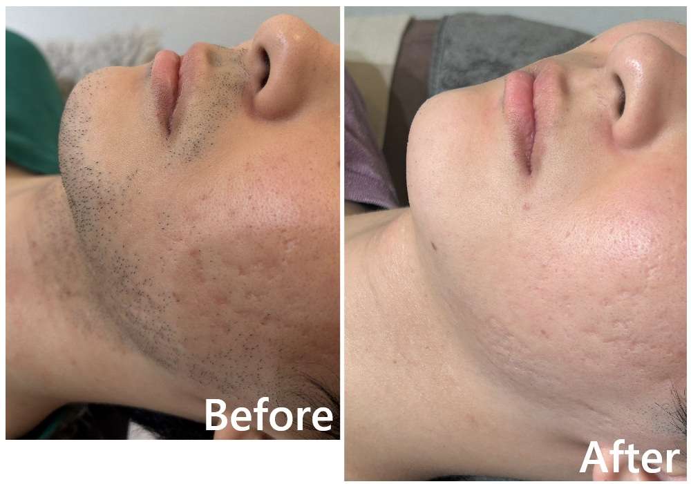 【IPL・SHR脱毛】20代メンズ脱毛【姫路エステ】